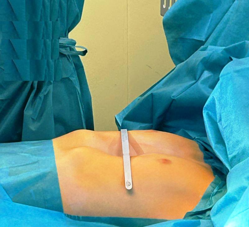Pectus_Excavatum_02